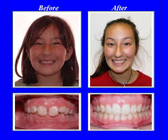 During this time, you need to wear rubber bands for 8 to 9 months that's the main component to correct the overbite. This Patient Had A Severe Overbite We Used Invisalign Aligners With Rubber Bands To Correct Her Overbite And S Orthodontics Perfect Smile Overbite Correction