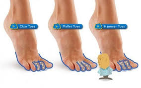Hammer Toes Clawed Toes Curly Toes Claw Toe Hammer Toe Toe Exercises