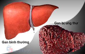 Image result for ung thư