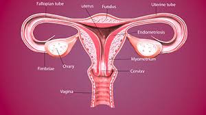Inversio Uteri Ursachen Symptome Behandlung Medlexi De