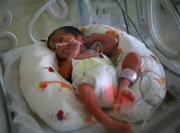 Dans cet article, nous vous informons des délais légaux pour avorter en france que ce soit par voie médicamenteuse ou par voie chirurgical. Ivg A Repetition Des Consequences Obstetricales Le Quotidien Du Medecin