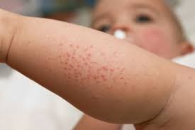 Baby S Skin Rashes Baby Skincare Huggies