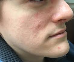 Skin Concerns Red Itchy Dry Skin I Use Cerave Moisturizing Face Wash Once A Day And Clinique Lotion After Sh Moisturizing Face Wash Dry Itchy Skin Face Wash