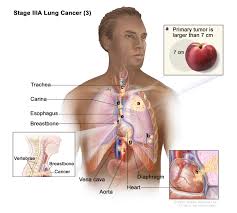 Image result for Lung Cancer