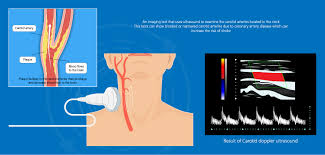 Image result for carotid artery