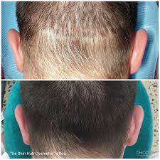 Scalp micropigmentation (smp), or scalp tattoo, is a highly specialised process where pigment is permanently inked into the dermal layer of the skin. Scalp The Skin Hub