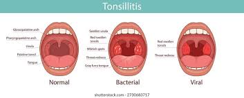 Image result for Pharyngitis