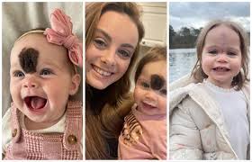 Roditelji poslali kćer na operaciju uklanjanja rijetkog madeža, a ovo je  rezultat