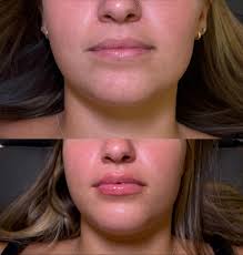 Botox: Fact vs. Myth. 🧠✨ It's crucial to separate the truth from the  rumors when it comes to your treatment. Botox isn't just for wrinkles