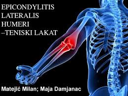 U ovome videu opisan je način rješavanja boli teniskog lakta transverz. Epicondylitis Lateralis Humeri Teniski Lakat Ppt Download