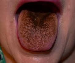 Image result for black hairy tongue symptoms