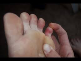 This toe is the most fragile and. Pinky 5th Toe Pain Best Home Treatment Guide Youtube