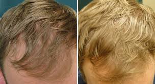 Hair loss is a major concern for many women and men, whether it is caused by age, genetics, hormones, medical conditions, or from styling practices, and/or products. Eclipse Prp Platelet Rich Plasma Therapy For Hair Growth And Healing Houston Tx Dr Nikko