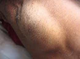 What causes painful lumps in armpits? Lump Under Armpit Painful Hard Male Female Sore Small Red Swollen Tender Lump In Armpit Hurts In 2020 Lump Under Armpit Armpit Lump Soreness