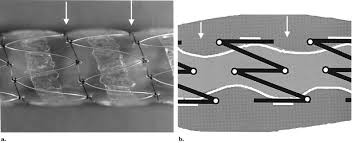 Zenith flex aaa endovascular graft, stent cook medical. Clinical Results Of The Internally Covered Spiral Z Stent For Malignant Esophagogastric Obstruction And The Reduction Of Stent Migration Journal Of Vascular And Interventional Radiology