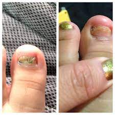 Nail fungus is considered as one of the most common types of fungal infections. I Ve Read About Apple Cider Vinegar For Toe Nail Fungus Truthful I Was Skeptical But To See My Bef Toenail Fungus Cure Toenail Fungus Treatment Toenail Fungus