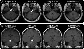 Video 2 or 9 from acep 2019. Figure Postcontrast Axial And Coronal Brain Mri In A Patient With Download Scientific Diagram