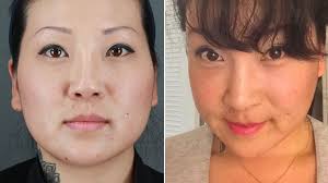 By far the most common surgery that koreans do, according to dr. South Korea S Growing Obsession With Cosmetic Surgery Abc News