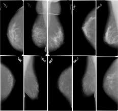 Macrocalcifications look like large white dots or lines. Images Data Practices For Semantic Segmentation Of Breast Cancer Using Deep Neural Network Springerlink