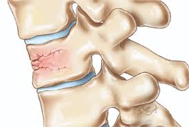 Image result for Spinal Trauma