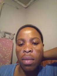 please house, anybody with chemical to remove this my mark. I need to  remove this mark Even the white men are making guess of me, they keep  asking me, you fights Lion?