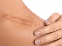 Stretch mark adalah kulit meregang lebih bicaralah dengan dokter kulit anda tentang apakah anda harus mencobanya. Kumpulan Berita Cara Menghilangkan Stretch Mark Dream Co Id