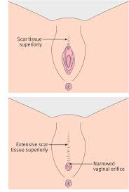 Klassifikation von fgm typ iii: Female Genital Mutilation An Overview The Bmj