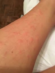 Best hair removal treatment for redheads. 1 Day Post Laser Hair Removal And Experience Very Itchy Red Bumps On Legs Is This Normal And What S The Cause Photos