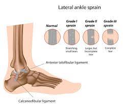 Superficial and deep deltoid ligaments 3.syndesmotic: Different Types Of Ankle Sprains Symptoms Treatment Options Bodyheal
