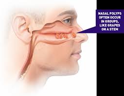 See information about a drug treatment option that may help patients manage nasal polyps. Could I Have Nasal Polyps Xhance Fluticasone Propionate