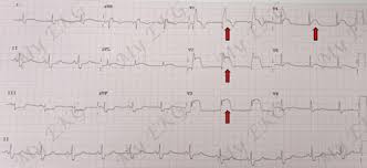 Enfarte agudo do miocárdio, vasoespasmo coronário, zolmitriptano, keywords: Infarto Agudo Com Elevacao Do Segmento St No Eletrocardiograma