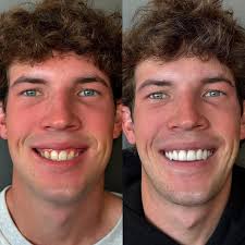 Teeth and your smile are so important. Unfortunately Brooks got my side of  the family and our congenital missing teeth: He is missing 3 front teeth  and 8 others for a very