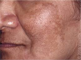 Image result for Diffuse Hyperpigmentation