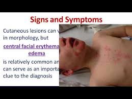 Dermatologic Emergencies 3 Drug Reaction With Eosinophilia And Systemic Symptoms Dress Syndrome Youtube