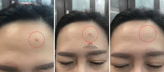 Sangat2 sesuai dengan wajah saya.saya sangat suka.tidak mengeringkan wajah.kulit saya jadi similar products. Review Get Clearer Skin In Two Weeks With New And Improved Eucerin Proacne Solution A I Clearing Treatment Angie Tangerine