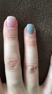 Meine gelnägel lösen sich nach wenigen tagen von den nn heißt ich kann sie abhebeln wenn ich vorne an der spitze leicht nach unten drücke gehen sie hinten am nagelrand vom naturnagel ab. Liftings Oben Am Rand Acrylnagel