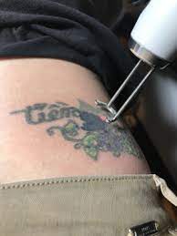 In this method of tattoo removal the tattoo is removed by broad spectrum light. Laser Tattoo Removal Royal Oak Mi Chroma Tattoo