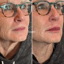 Angie Hayes — Bare. Medical Aesthetics