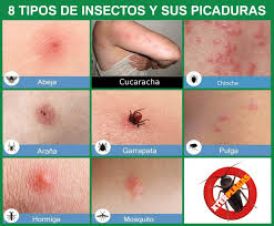 Aunque se pueden dar picotazos solitarios, a menudo estos siguen una disposición lineal siguiendo las venas que transportan la sangre por debajo de la piel. Tipos De Picaduras De Insectos Fumigacion Y Control Plagas Xterplagas