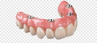 Dental implant Dentures Removable partial denture Dental prosthesis  Dentistry, bridge, gums, bridge png | PNGEgg