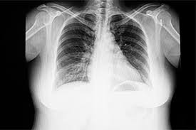 Carcinophobia, or the fear of getting cancer, typically affects those who have had the disease or have known people afflicted with it. Overcome Fear Of Cancer Hypnosis Downloads