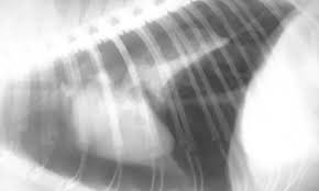 Image result for Pneumothorax