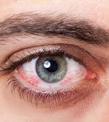 Red Eyes Develop With Many Causes At Times They Can Be A Serious Problem Associated With Many Other Signs Kno Red Veins In Eyes Puffy Eyes Red Eye Infection
