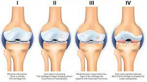 Osteoarthritis Pathophysiology Clinical Features Teachmesurgery