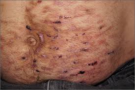 Image result for Neurotic Excoriation