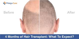 You should expect hair that is shaved for the fue procedure to grow back right away at the normal rate of 1/2mm per day. 4 Months Of Hair Transplant What To Expect Pristyn Care