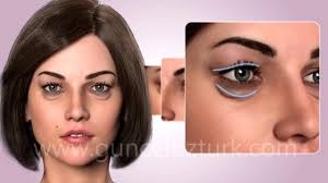 Facelift pulled trump's face overly. Cosmetic Eye Surgery Upper And Lower Eyelid Aesthetic Blepharoplasty Guncel Ozturk Md Youtube