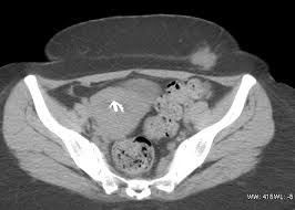 A pragmatic approach paolovercellini et.al. Scar Endometriosis Ct Radiology Case Radiopaedia Org