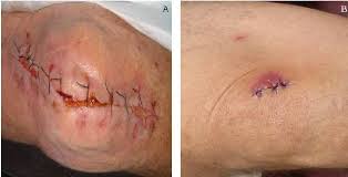 Close and dress the wound: Pdf Comparison Of Sterile And Clean Dressing Techniques In Post Operative Surgical Wound Infection In A Chinese Healthcare Facility Semantic Scholar