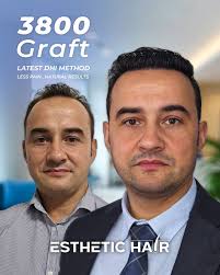 Turkish Hair Transplant in Cancun/Mexico